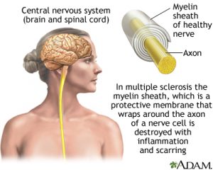 New multiple sclerosis listing